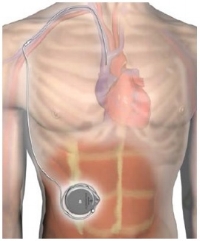 Med Device Monday: Implantable Continuous Pump for Remodulin