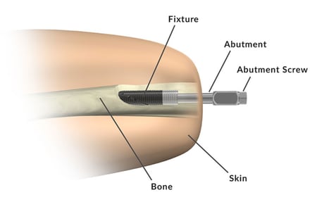 Med Device Monday - FDA Approves Prosthetic Implant for Above-the-Knee Amputations