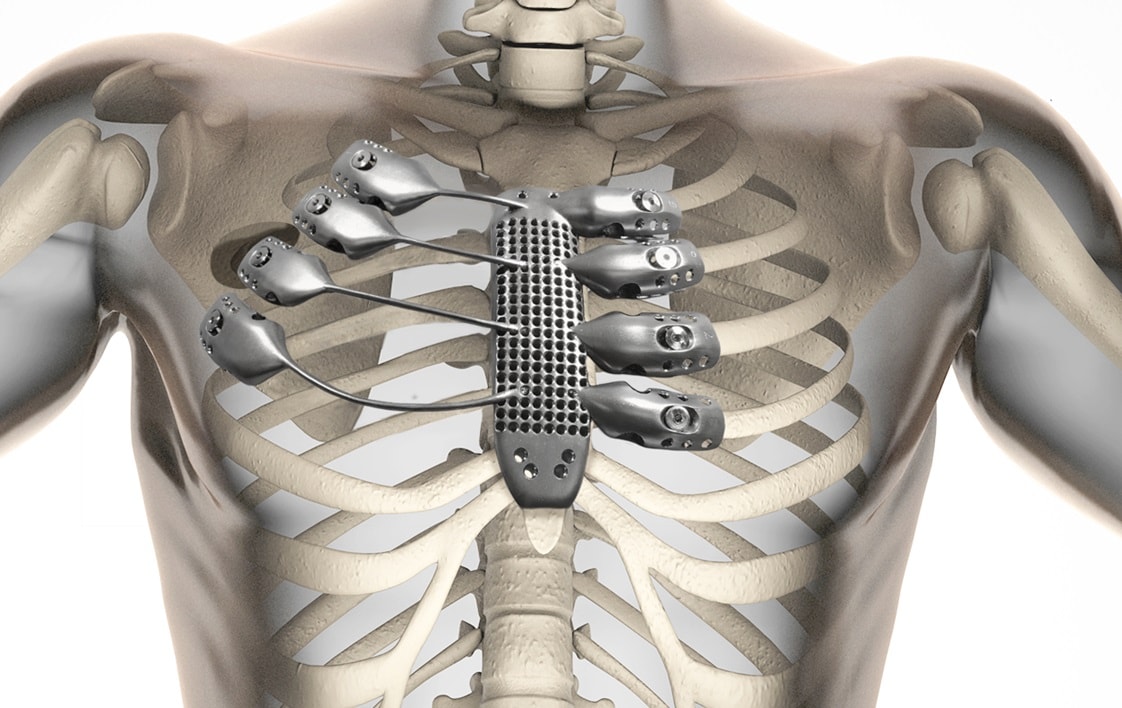 The Med Device Industry (and the FDA) Embrace 3D Printing Innovation