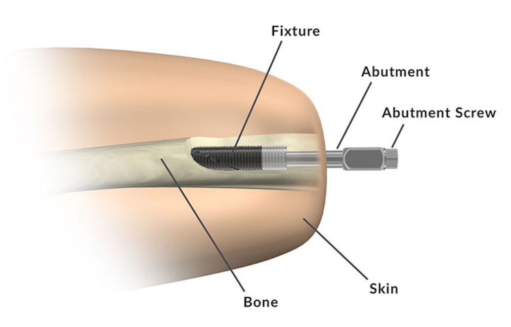Image of prosthetic implant for above-the-knee amputations from https://integrum.se/